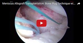 Meniscus Allograft Transplantation: Bone Plug Technique with ACL BPTB Allograft Reconstruction 