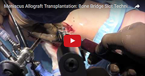 Meniscus Allograft Transplantation – Bone Bridge