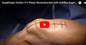 Quadriceps Tendon V-Y Plasty Reconstruction with Achilles Augmentation for Failed Quad Tendon Repair