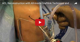 ACL Reconstruction with All-Inside Graftlink Technique and Hamstring Allograft