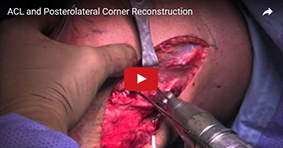 Posterolateral Reconstruction