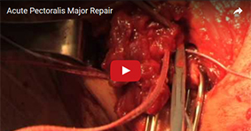 Acute Pectoralis Major Repair