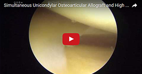 Salvage Joint Preservation: Unicondylar Osteoarticular Allograft and High Tibial Osteotomy
