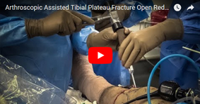 Arthroscopic Assisted Tibial Plateau Fracture Open Reduction Internal Fixation (ORIF)