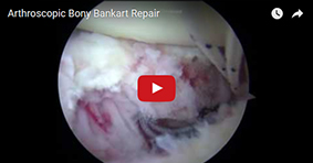 Arthroscopic Bony Bankart Repair 