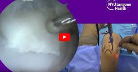 Arthroscopic Debridement and Microfracture of Osteochondritis Dissecans of the Capitellum