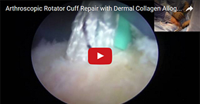 Arthroscopic Rotator Cuff Repair with Dermal Collagen Allograft Patch