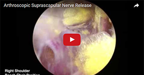 Arthroscopic Suprascapular Nerve Release
