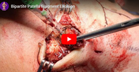 Bipartite Patella Fragment Excision