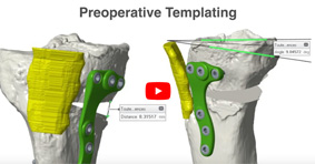 Biplanar HTO for Sagital Malalignment in Revision ACL Reconstruction