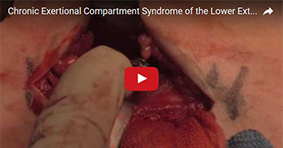 Chronic Exertional Compartment Syndrome of the Lower Extremity: Surgical Management 