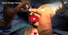 Distal Biceps Repair