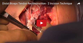 Distal Biceps Tendon Reconstruction – 2 Incision Technique