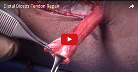 Distal Biceps Tendon Repair