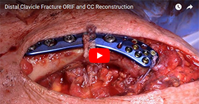 Distal Clavicle Fracture ORIF and CC Reconstruction