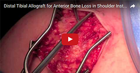 Distal Tibial Allograft for Anterior Bone Loss in Shoulder Instability