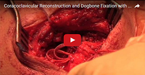 Coracoclavicular Reconstruction and Dogbone Fixation with CA Ligament Augmentation