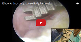 Elbow Arthroscopy: Loose Body Removal