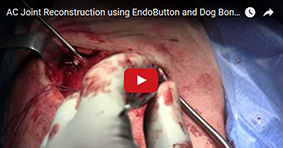 AC Joint Reconstruction using EndoButton and Dog Bone Technique 