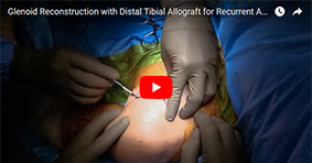 Glenoid Reconstruction with Distal Tibial Allograft for Recurrent Anterior Shoulder Instability