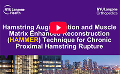 Chronic Proximal Hamstring Rupture Reconstruction with Achilles Allograft: HAMMER Surgical Technique
