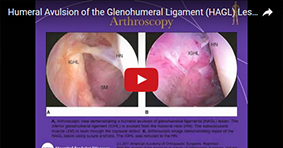 Humeral Avulsion of the Glenohumeral Ligament (HAGL) Lesion