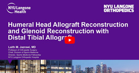 Humeral Head Allograft Reconstruction and Glenoid Reconstruction with Distal Tibial Allograft