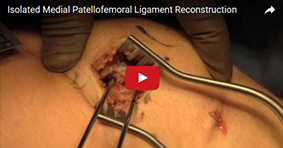 Isolated Medial Patellofemoral Ligament Reconstruction