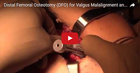 Distal Femoral Osteotomy (DFO) for Valgus Malalignment and Lateral Compartment Cartilage Lesion
