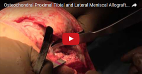 Osteochondral Proximal Tibial and Lateral Meniscal Allograft Transplant 