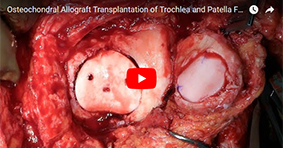 Osteochondral Allograft Transplantation of Trochlea and Patella Following Failed MACI