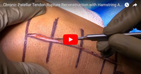 Chronic Patellar Tendon Rupture Reconstruction with Hamstring Autograft and MCL Repair