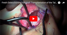 Fresh Osteochondral Allograft Transplantation of the Talus via Medial Malleolar Osteotomy 