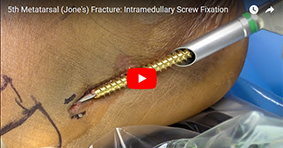 5th Metatarsal (Jone's) Fracture: Intramedullary Screw Fixation