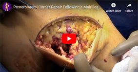 Posterolateral Corner Repair Following a Multiligamentous Knee Injury