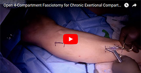 Open 4-Compartment Fasciotomy for Chronic Exertional Compartment Syndrome of the Leg
