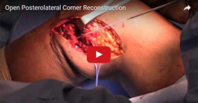Open Posterolateral Corner Repair