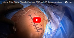 Lateral Third Distal Clavicle Fracture ORIF and CC Reconstruction