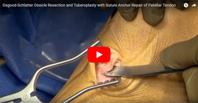 Tibial Tubercle Osteotomy and Proximalization for Chronic Patella Baja