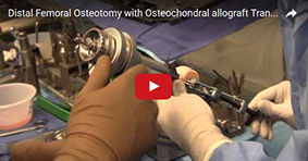 Distal Femoral Osteotomy with Osteochondral Allograft Transplant