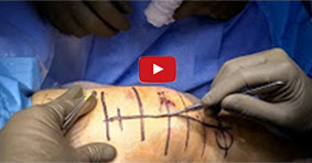 Patella Fracture Reduction and Fixation Using Cannulated Screws and Tension Band Wiring