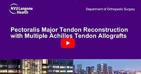 Pectoralis Major Tendon Reconstruction with Multiple Achilles Tendon Allografts