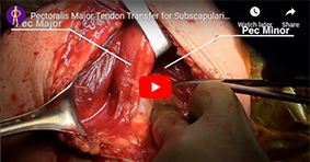 Pectoralis Major Tendon Transfer for Subscapularis Insufficiency