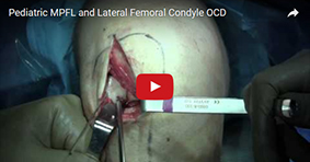 Pediatric MPFL and Lateral Femoral Condyle OCD