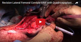 Revision Lateral Femoral Condyle ORIF with Quadricepsplasty and MPFL Reconstruction