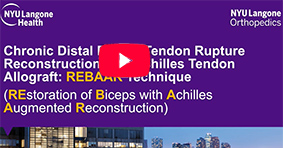 Chronic Distal Biceps Tendon Rupture Reconstruction with Achilles Tendon Allograft: REBAAR Technique
