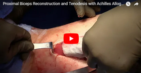 Proximal Biceps Reconstruction and Tenodesis with Achilles Allograftn