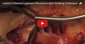 Lateral Collateral Ligament Reconstruction Docking Technique