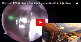 Revision ACL (Anterior Cruciate Ligament) with ALL (Anterolateral Ligament) Reconstruction