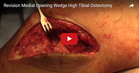 Revision Medial Opening Wedge High Tibial Osteotomy with Plate Fixation